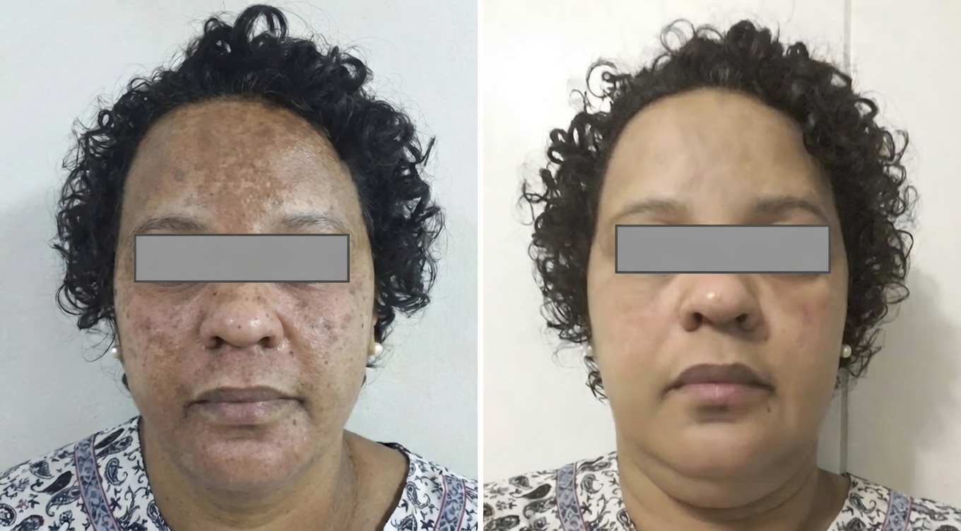 Resultado de Melasma