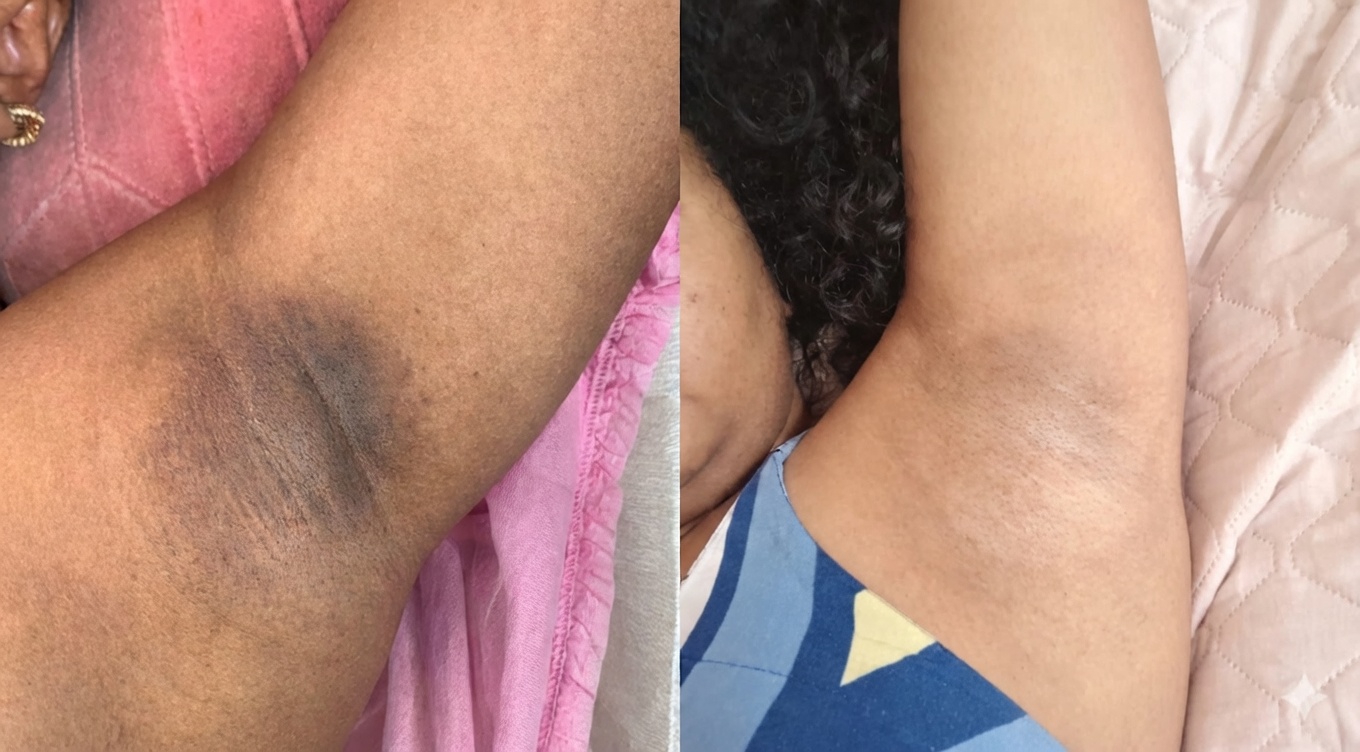 Resultado de Axilas Escuras